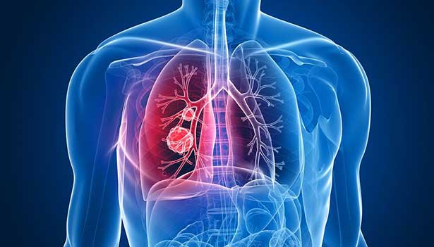 Akciğerdeki her kitle kanser midir?